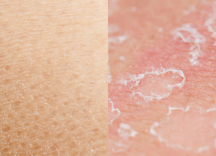 differenza pelle secca e disidratata